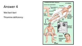 Answer 4
Wet beri-beri
Thiamine deficiency
 