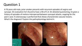 Question 1
A 76 years old male, prior smoker presents with recurrent episodes of angina and
syncope. On evaluation he’s found to have a Hb of 5.4. On detailed questioning, he gives a
history of episodes of melena interspersed between syncopal attacks, ongoing for the
past 1 year. A colonoscopy is performed that shows characteristic vascular lesions.
What’s the diagnosis? Explain the pathophysiology behind it.
 
