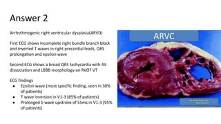 Answer 2
Arrhythmogenic right ventricular dysplasia(ARVD)
First ECG shows incomplete right bundle branch block
and inverted T waves in right precordial leads, QRS
prolongation and epsilon wave
Second ECG shows a broad QRS tachycardia with AV
dissociation and LBBB morphology-an RVOT VT
ECG findings
● Epsilon wave (most specific finding, seen in 30%
of patients)
● T wave inversion in V1-3 (85% of patients)
● Prolonged S-wave upstroke of 55ms in V1-3 (95%
of patients)
 