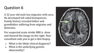 Question 6
A 32 year old male has migraine with aura.
He developed left sided hemiparesis.
Family history revealed father and
grandfather suffering from migraine and
dementia.
For suspected acute stroke MRI is done
and showed the image on the right. Your
consultant asks you to get a skin biopsy.
● What is the likely clinical diagnosis?
● What is the underlying genetic
abnormality?
 