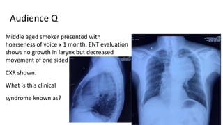 Audience Q
Middle aged smoker presented with
hoarseness of voice x 1 month. ENT evaluation
shows no growth in larynx but decreased
movement of one sided vocal cords.
CXR shown.
What is this clinical
syndrome known as?
 