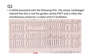 Q1
• A 20/M presented with the following ECG. The astute cardiologist
noticed that this is not the garden variety PSVT and is infact the
simultaneous presence a culprit and it’s facililtator.
 