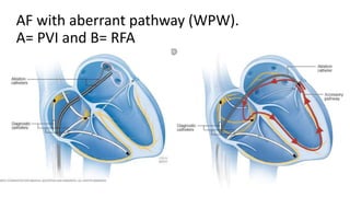 AF with aberrant pathway (WPW).
A= PVI and B= RFA
 