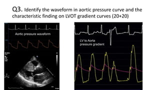 Q3. Identify the waveform in aortic pressure curve and the
characteristic finding on LVOT gradient curves (20+20)
Aortic pressure waveform
LV to Aorta
pressure gradient
 