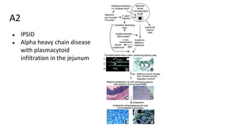A2
● IPSID
● Alpha heavy chain disease
with plasmacytoid
infiltration in the jejunum
 