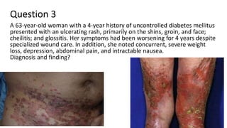 Question 3
A 63-year-old woman with a 4-year history of uncontrolled diabetes mellitus
presented with an ulcerating rash, primarily on the shins, groin, and face;
cheilitis; and glossitis. Her symptoms had been worsening for 4 years despite
specialized wound care. In addition, she noted concurrent, severe weight
loss, depression, abdominal pain, and intractable nausea.
Diagnosis and finding?
 
