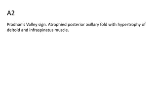 A2
Pradhan’s Valley sign. Atrophied posterior axillary fold with hypertrophy of
deltoid and infraspinatus muscle.
 