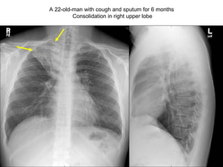 A 22-old-man with cough and sputum for 6 months  Consolidation in right upper lobe 