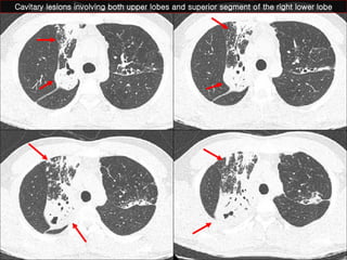 Cavitary lesions involving both upper lobes and superior segment of the right lower lobe 