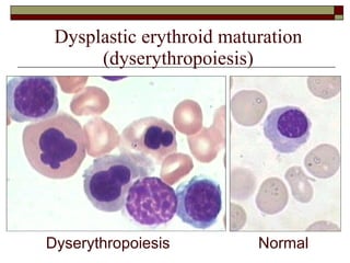 Dysplastic erythroid maturation (dyserythropoiesis) Normal Dyserythropoiesis 