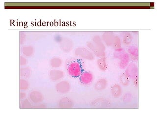 Ring sideroblasts 