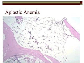 Aplastic Anemia 