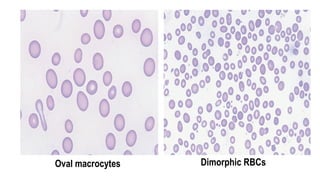 Oval macrocytes Dimorphic RBCs
 