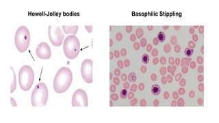 Howell-Jolley bodies Basophilic Stippling
 