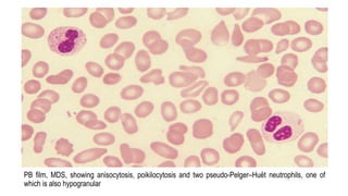 PB film, MDS, showing anisocytosis, poikilocytosis and two pseudo-Pelger–Huët neutrophils, one of
which is also hypogranular
 