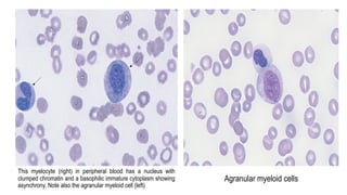This myelocyte (right) in peripheral blood has a nucleus with
clumped chromatin and a basophilic immature cytoplasm showing
asynchrony. Note also the agranular myeloid cell (left)
Agranular myeloid cells
 