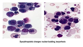 Dysrythropoietic changes- nuclear budding, karyorhexis
 