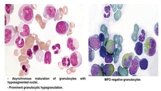 - Asynchronous maturation of granulocytes with
hyposegmented nuclei.
- Prominent granulocytic hypogranulation.
MPO negative granulocytes
 