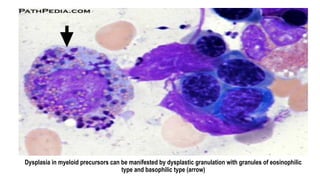 Dysplasia in myeloid precursors can be manifested by dysplastic granulation with granules of eosinophilic
type and basophilic type (arrow)
 