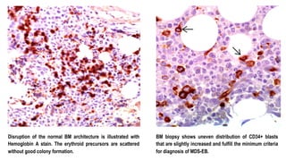 Disruption of the normal BM architecture is illustrated with
Hemoglobin A stain. The erythroid precursors are scattered
without good colony formation.
BM biopsy shows uneven distribution of CD34+ blasts
that are slightly increased and fulfill the minimum criteria
for diagnosis of MDS-EB.
 