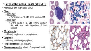 5. MDS with Excess Blasts (MDS-EB)
• Aggressive form (high grade MDS).
• Blasts:
oMDS-EB1:
§ 2-4% blasts in PB, OR 5-9% blasts in BM.
oMDS-EB2:
§ 5-19% blasts in PB, OR 10-19% blasts in
BM, OR Auer rods regardless of blast
percent.
• PB cytopenia:
oUsually bicytopenia or pancytopenia.
• Dysplasia:
oUsually multilineage dysplasia.
• Ring sideroblasts: not relevant.
• Disease progression: about 1/3 progress to AML.
 