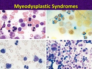 Myeodysplastic SyndromesMyeodysplastic Syndromes
 