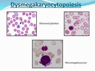Abnormal platelets
Micromegakaryocyte
Dysmegakaryocytopoiesis
 