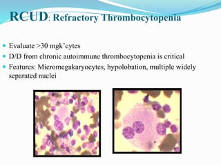 RCUD: Refractory Thrombocytopenia
 Evaluate >30 mgk’cytes
 D/D from chronic autoimmune thrombocytopenia is critical
 Features: Micromegakaryocytes, hypolobation, multiple widely
separated nuclei
 