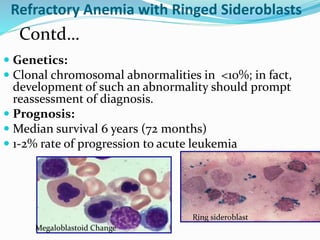 Refractory Anemia with Ringed Sideroblasts
 Genetics:
 Clonal chromosomal abnormalities in <10%; in fact,
development of such an abnormality should prompt
reassessment of diagnosis.
 Prognosis:
 Median survival 6 years (72 months)
 1-2% rate of progression to acute leukemia
Contd…
Ring sideroblast
Megaloblastoid Change
 