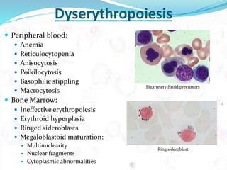 Dyserythropoiesis
 Peripheral blood:
 Anemia
 Reticulocytopenia
 Anisocytosis
 Poikilocytosis
 Basophilic stippling
 Macrocytosis
 Bone Marrow:
 Ineffective erythropoiesis
 Erythroid hyperplasia
 Ringed sideroblasts
 Megaloblastoid maturation:
 Multinuclearity
 Nuclear fragments
 Cytoplasmic abnormalities
Bizarre erythroid precursors
Ring sideroblast
 