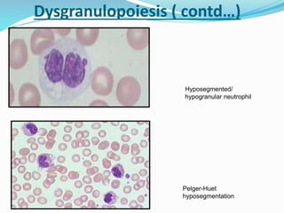 Hyposegmented/
hypogranular neutrophil
Pelger-Huet
hyposegmentation
Dysgranulopoiesis ( contd…)
 