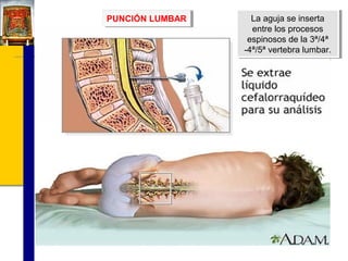 PUNCIÓN LUMBAR
PUNCIÓN LUMBAR

La aguja se inserta
La aguja se inserta
entre los procesos
entre los procesos
espinosos de la 3ª/4ª
espinosos de la 3ª/4ª
-4ª/5ª vertebra lumbar.
-4ª/5ª vertebra lumbar.

 