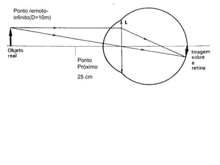 Ponto
Próximo
25 cm
Ponto remoto-
infinito(D>10m)
 