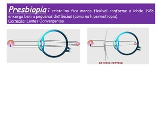 Presbiopia: cristalino fica menos flexível conforme a idade. Não
enxerga bem a pequenas distâncias (como na hipermetropia).
Correção: Lentes Convergentes
 