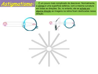 Astigmatismo: É um pouco mais complicado de descrever. Normalmente,
a córnea é uma superfície esférica, com a mesma curvatura
em todas as direções. Se, no entanto, ela se achata em
alguma direção as imagens na retina ficam desfocadas nessa
direção.
 