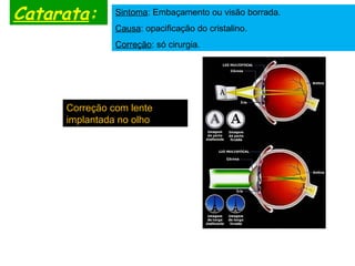 Catarata: Sintoma: Embaçamento ou visão borrada.
Causa: opacificação do cristalino.
Correção: só cirurgia.
Correção com lente
implantada no olho
 