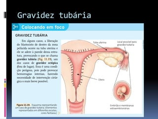Gravidez tubária
