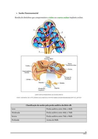  
37
LIBRAS 
 Surdez Neurossensorial
Resulta de distúrbios que comprometem a cóclea ou o nervo coclear implante coclear.
CORTE VERTICOTRANSVERSAL DO OUVIDO DIREITO 
FONTE: DISPONÍVEL EM: HTTP://WWW.SCIELO.BR/SCIELO.PHP?PID=S0080‐62342007000300020&SCRIPT=SCI_ARTTEXT 
Classificação da surdez pela perda auditiva decibéis=db
Leve Perda auditiva entre 20dc e 40db
Moderada Perda auditiva entre 40dc e 70db
Severa Perda auditiva entre 70dc e 90db
Profunda Acima de 90db
 