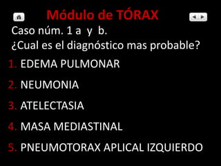 1.EDEMA PULMONAR 
2.NEUMONIA 
3.ATELECTASIA 
4.MASA MEDIASTINAL 
5.PNEUMOTORAX APLICAL IZQUIERDO 
Caso núm. 1 a y b. 
¿Cual es el diagnóstico mas probable? 
Módulo de TÓRAX  