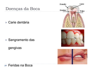 Doenças da Boca
 Carie dentária
 Sangramento das
gengivas
 Feridas na Boca
 