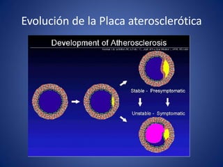 Evolución de la Placa aterosclerótica
 