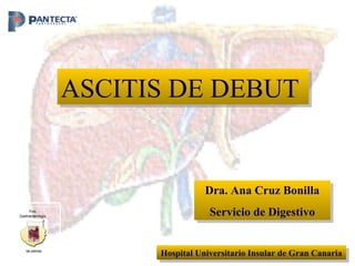 Dra. Ana Cruz Bonilla Servicio de Digestivo Hospital Universitario Insular de Gran Canaria ASCITIS DE DEBUT Foro Gastroenterología las palmas 