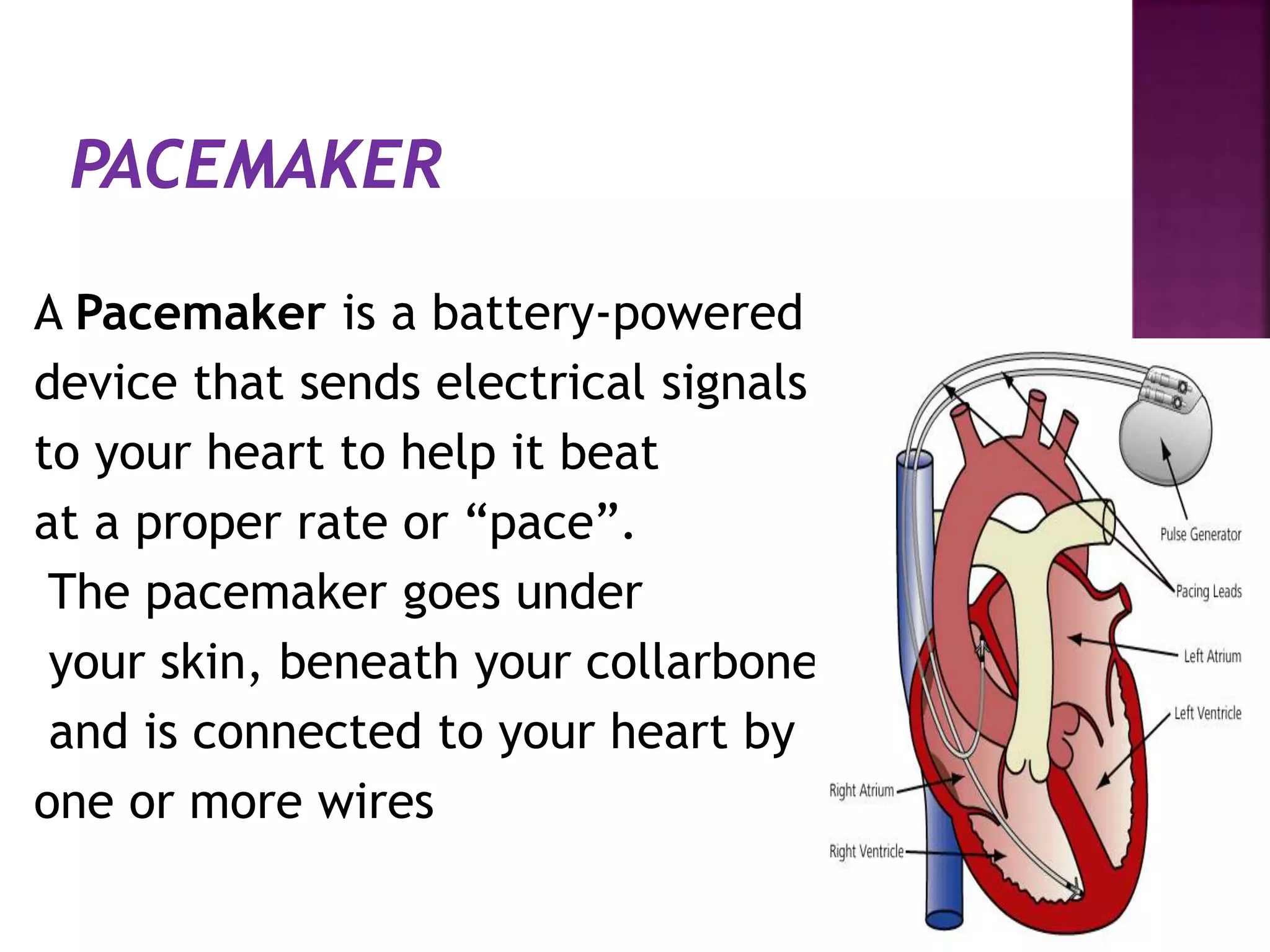 A Pacemaker is a battery-powered
device that sends electrical signals
to your heart to help it beat
at a proper rate or “pace”.
The pacemaker goes under
your skin, beneath your collarbone
and is connected to your heart by
one or more wires
 