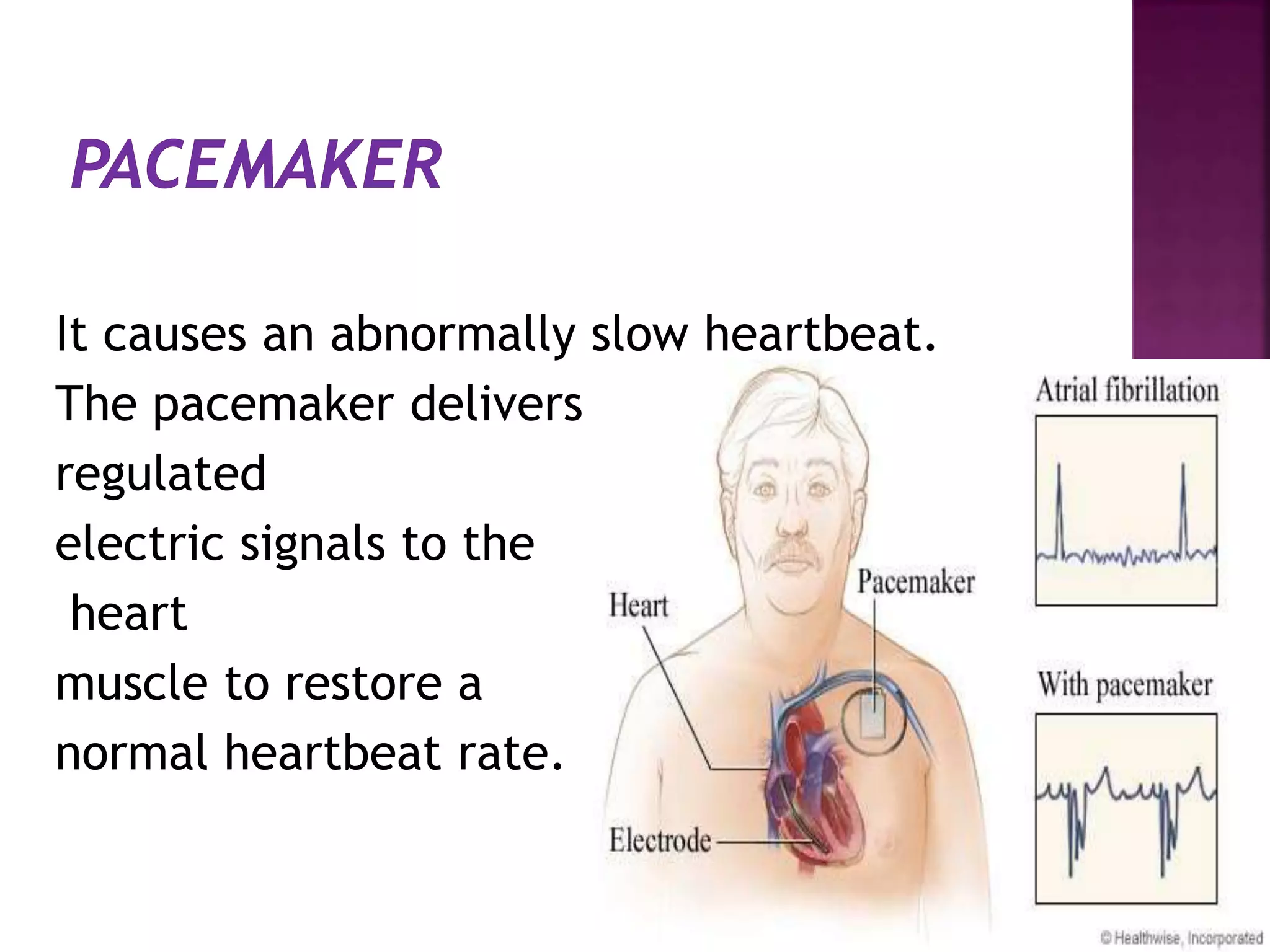 It causes an abnormally slow heartbeat.
The pacemaker delivers
regulated
electric signals to the
heart
muscle to restore a
normal heartbeat rate.
 