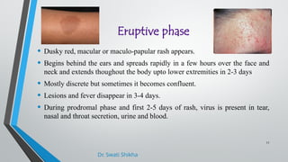 Extensor Rash Measels.pptx77777777777777777777777777777 | PPTX
