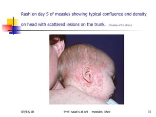 Rash on day 5 of measles showing typical confluence and density on head with scattered lesions on the trunk.   (Courtesy o...
