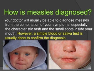 How is measles diagnosed?
Your doctor will usually be able to diagnose measles
from the combination of your symptoms, especially
the characteristic rash and the small spots inside your
mouth. However, a simple blood or saliva test is
usually done to confirm the diagnosis.
 