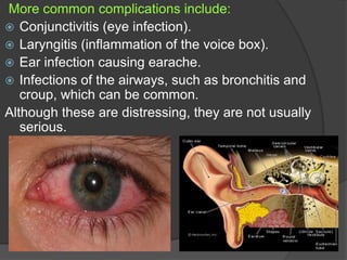 More common complications include:
 Conjunctivitis (eye infection).
 Laryngitis (inflammation of the voice box).
 Ear infection causing earache.
 Infections of the airways, such as bronchitis and
croup, which can be common.
Although these are distressing, they are not usually
serious.
 