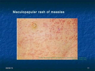 08/06/1508/06/15 1111
Korting GW: Hautkrankheiten bei Kindern und Jugendlichen, 3rd ed. Stuttgart, FK
Schattauer Verlag, 1982
Maculopapular rash of measles
 