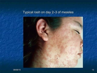 08/06/1508/06/15 1313
Typical rash on day 2–3 of measlesTypical rash on day 2–3 of measles   
 